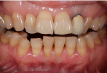 セラミック治療症例01前