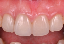 セラミック治療症例02後