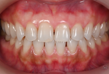 貼るホワイトニング症例01前
