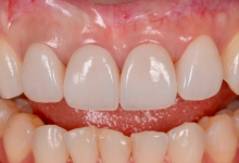 貼るホワイトニング症例02後