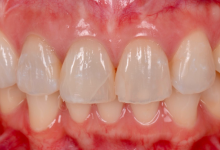 貼るホワイトニング症例02前